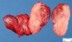 Thyroid papillary carcinoma