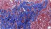 Portal fibrosis and biliary ductular proliferation in juvenile (...)
