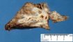 Bronchiectasis and BALT hyperplasia (Case 11750)