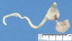 Anorectal agenesis with rectovesical fistula