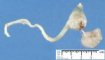 Unilateral renal agenesis with anorectal agenesis and rectovesical (...)