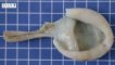 hydatid cyst (echinococcosis)