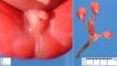 Anal imperforation with rectovesical fistula and hypospadias (22 (...)