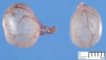 vesicular appendage of epoophoron