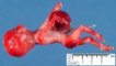 Omphalocele-radial ray aplasia complex (13w)