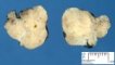 Salivary gland anlage tumor