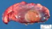 Subpleural hemorrhagic pseudocyst (subpleural hematoma)