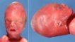 Oligohydramnios facies (23 weeks)