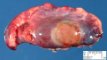 Subpleural hemorrhagic pseudocyst (etiology unknown)