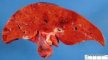 Hepatic necrosis in adenoviral hepatitis