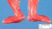 Rocker-bottom feet in polymalformative syndrome (Case 10783)