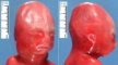 Facial anomalies in trisomy 18