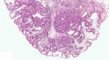 Gastric Peutz-Jeghers polyp