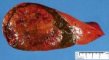 Hepatoblastoma