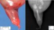 Caudal regression syndrome with sirenomelia unipus