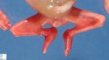 Caudal regression syndrome with lumbosacral agenesis and situs (...)