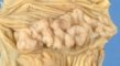 Gastric heterotopia in small intestine
