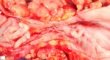 Colonic stenosis in Crohn disease