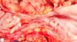 Colonic stenosis in Crohn disease
