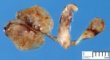 Renal hypodysplasia (Case #11194)