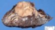 Bronchial carcinoid tumor