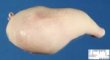 Enchondroma in Maffucci syndrome