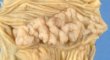 Gastric heterotopia in small intestine