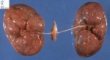 non-syndromal bilateral non-obstructive renal dysplasia