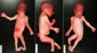 Club feet in a spina bifida with myelomeningocele (neonate)