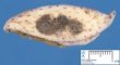 Superficial spreading melanoma