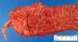 Colectomy of ulcerative colitis