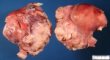 Uterine leiomyosarcoma