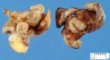 Meckel diverticula with ileal perforation