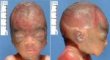 Oligohydramnios face (23 weeks)