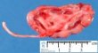 Ureteropelvic junction obstruction