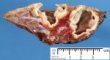 Hydatid cysts in pulmonary echinococcosis