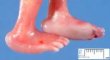 Rocker-bottom feet associated with posterior encephalocele