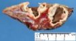 Pulmonary hydatid cysts (pulmonary echinococcosis)