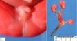 Rectourethral fistula