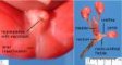 Association of anal imperforation with rectourethral fistula