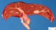 Choledochal atresia and choledochal dilatation in multiple intestinal (...)