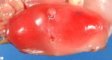 Caudal dysplasia and lower limb agenesis in maternal diabetes (Case (...)