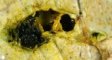 Cystic dilatation of a large bile duct in extrahepatic biliary tract (...)