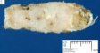 Enchondroma in Maffucci syndrome