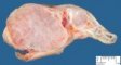 Enchondroma in Maffucci syndrome