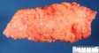 Mature lipoma