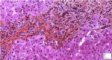Portal fibrosis and biliary ductular proliferation in juvenile (...)
