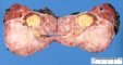 Hepatoblastoma