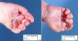Fifth finger clinodactyly