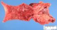 Crohn ileitis